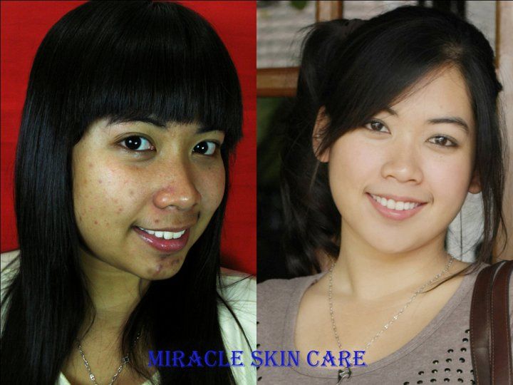 beforeafterhana_zps075708ab.jpg